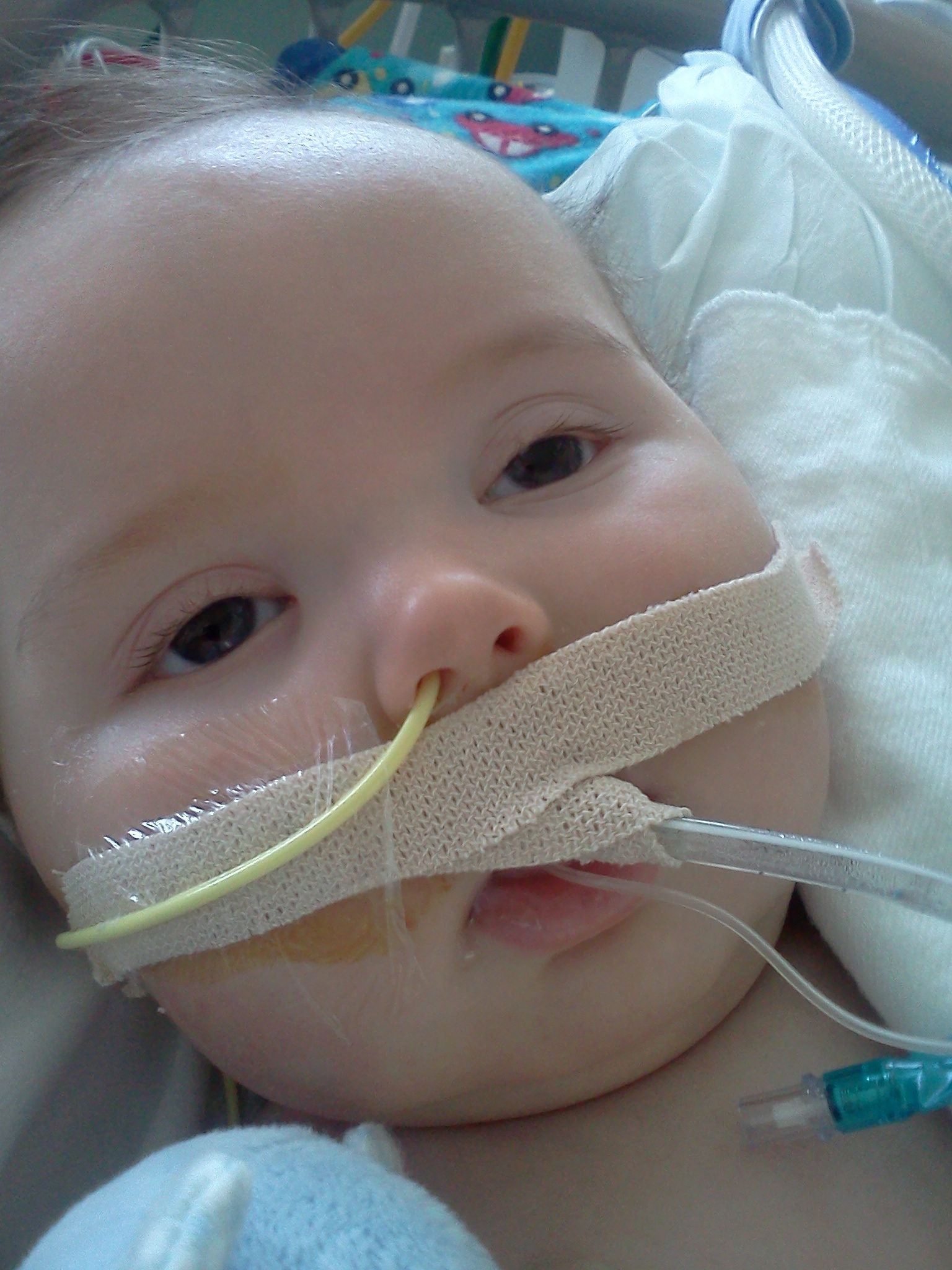 Patient with infant bolulism Patient with infant bolulism