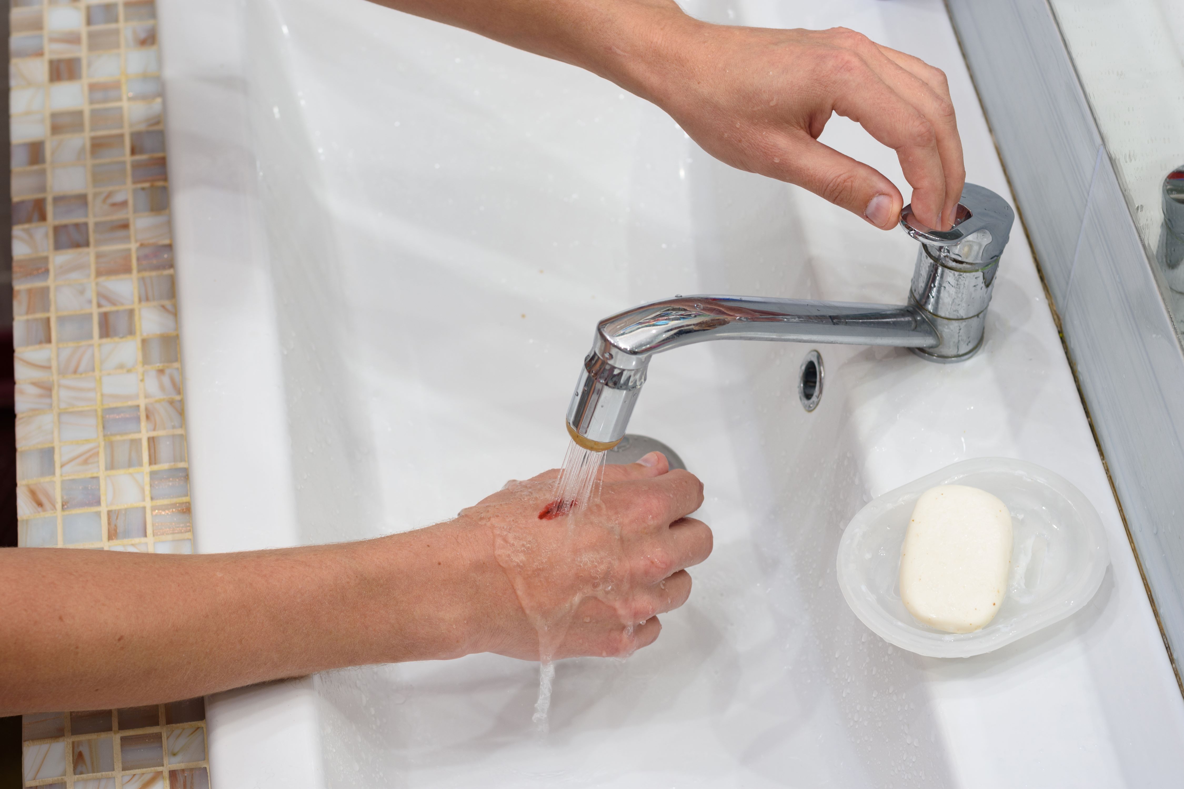 Person washing a wound on their hand under running water.